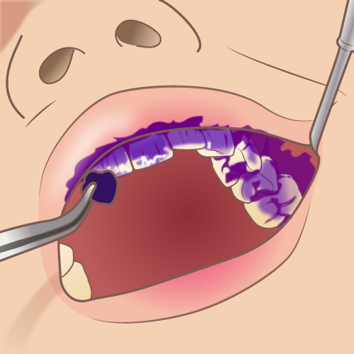 歯の汚れを染め出します1