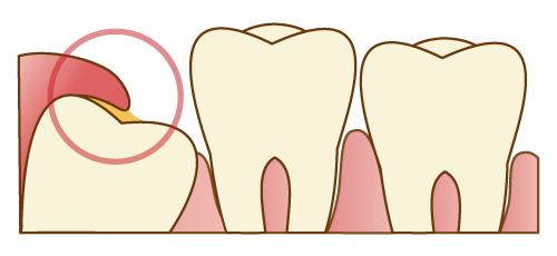 斜めに生えかけた親知らずの周りの歯ぐきが炎症をおこします