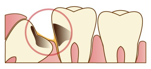 斜めに生えた親知らずと前の歯がむし歯になっています