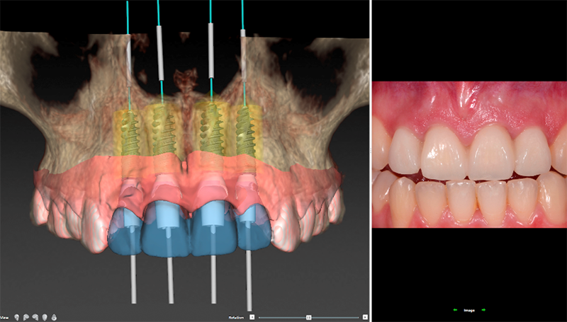トップダウン・トリートメント