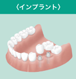 インプラント