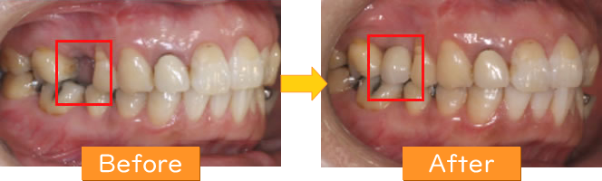 インプラント症例1
