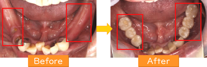 インプラント症例2